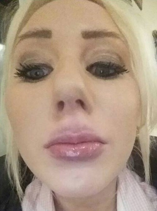 Woman Tries To Do A DIY Kylie Jenner Lip Job And It Doesn't End Well (3 pics)