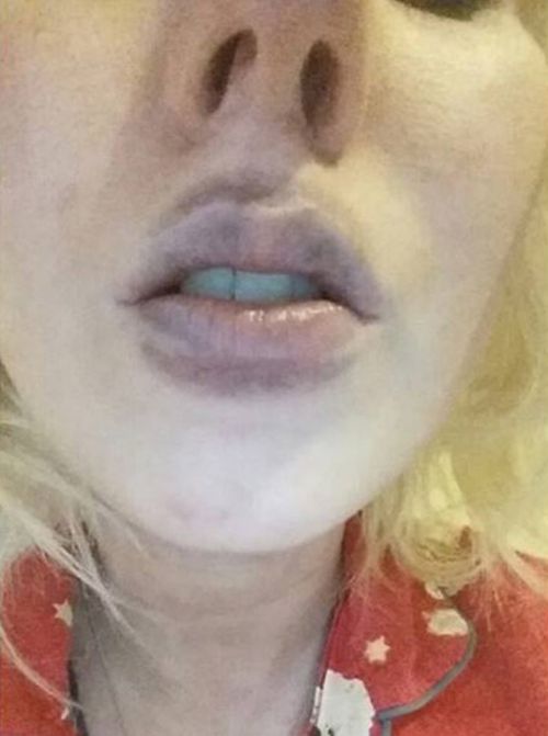 Woman Tries To Do A DIY Kylie Jenner Lip Job And It Doesn't End Well (3 pics)