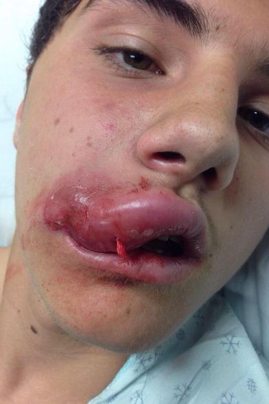 The Kylie Jenner Lip Challenge Has Turned Into A Complete Disaster (19