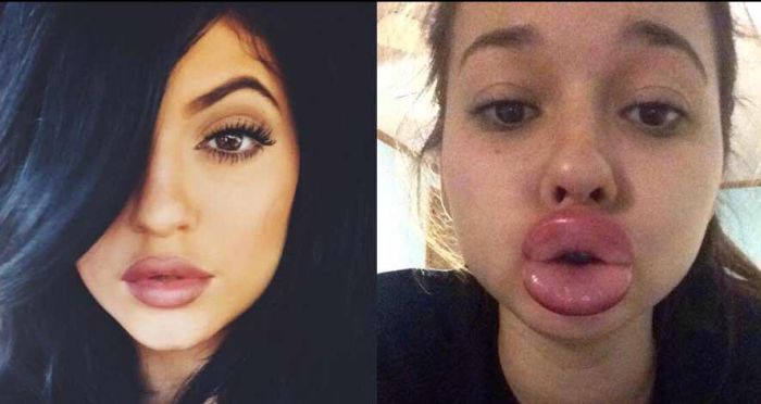 The Kylie Jenner Lip Challenge Has Turned Into A Complete Disaster 19 Pics