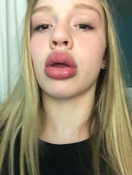 The Kylie Jenner Lip Challenge Has Turned Into A Complete Disaster (19