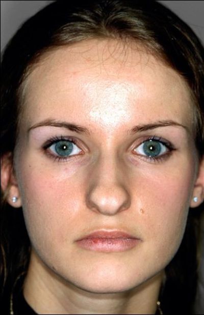 Before And After Pictures Show How A Nose Job Can Change Your Face (8 pics)