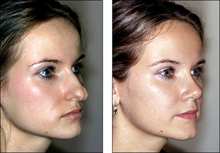 Before And After Pictures Show How A Nose Job Can Change Your Face 8 Pics 