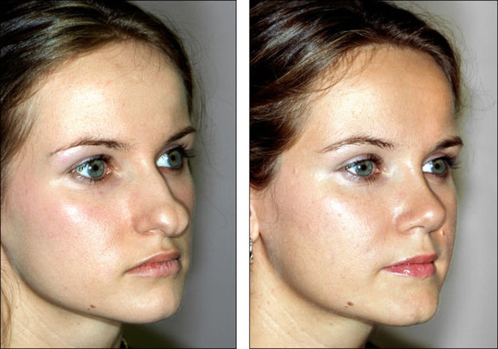 Before And After Pictures Show How A Nose Job Can Change Your Face (8 pics)
