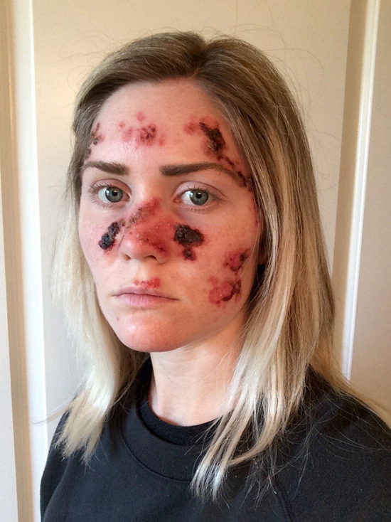 Woman Shows The Dangers Of Tanning With Graphic Selfie (5 pics)