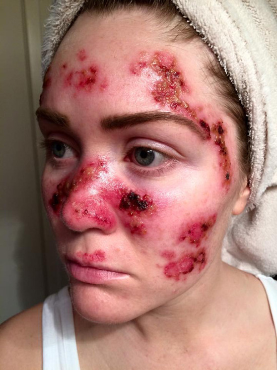 Woman Shows The Dangers Of Tanning With Graphic Selfie (5 pics)
