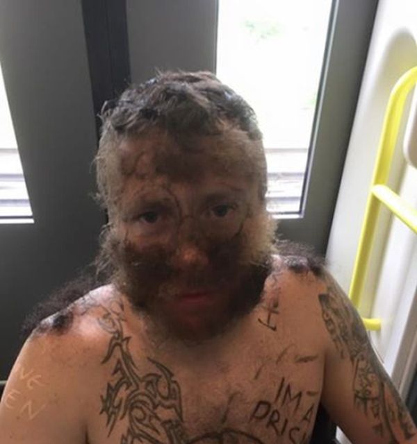 This Guy's Friends Glued Pubic Hair To His Face For His Bachelor Party (3 pics)