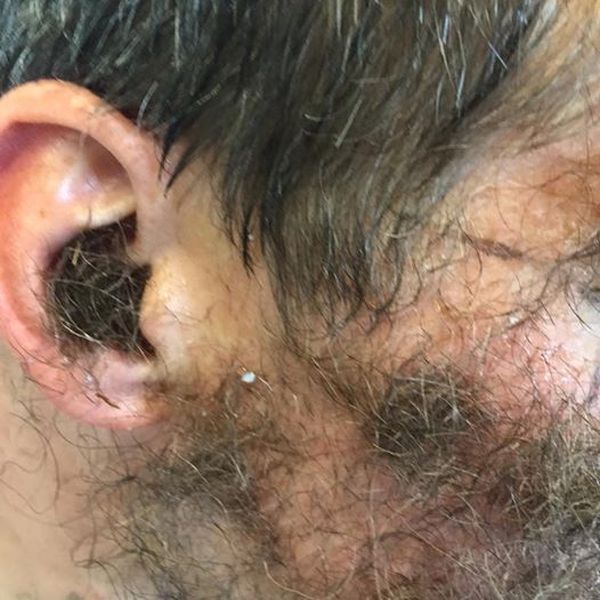 This Guy's Friends Glued Pubic Hair To His Face For His Bachelor Party (3 pics)