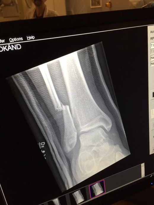 Dave Grohl Broke His Leg During A Foo Fighters Concert And Finished The Show  (3 pics + video)