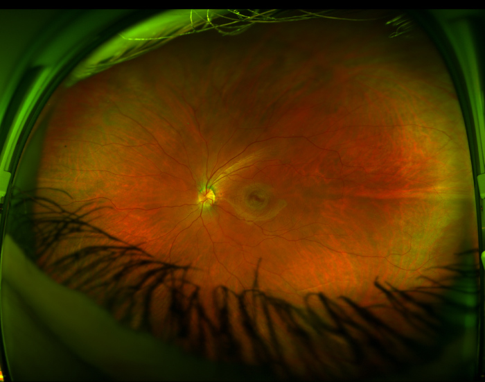 This Is What The Back Of An Eyeball Looks Like