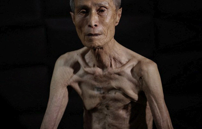 Nagasaki Bomb Survivor Shows Off The Scars Of Nuclear War (10 pics)