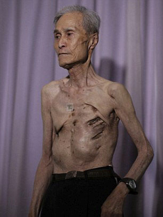 Nagasaki Bomb Survivor Shows Off The Scars Of Nuclear War (10 pics)