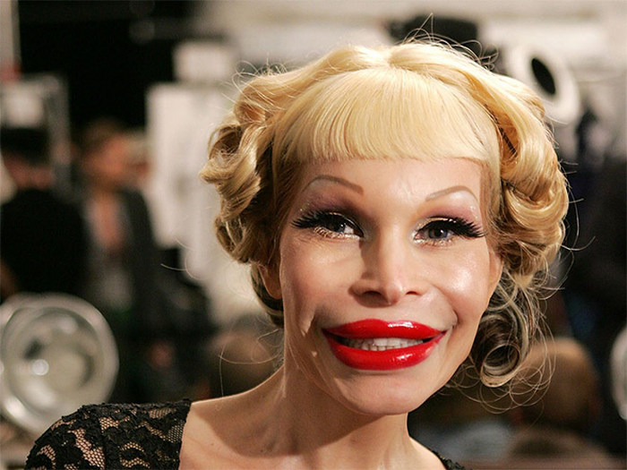 Plastic Surgery Gone Wrong (17 pics)