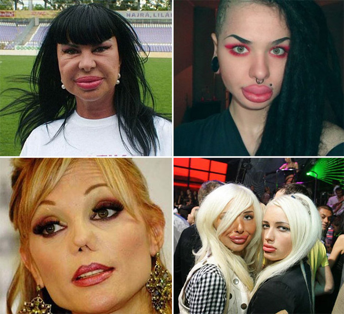 Plastic Surgery Gone Wrong (17 pics)