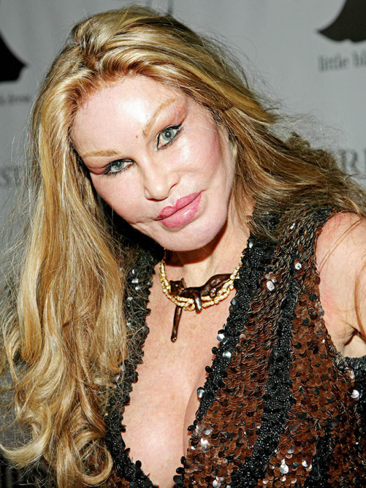 Plastic Surgery Gone Wrong (17 pics)