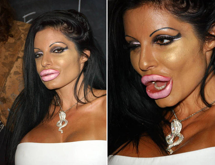 Plastic Surgery Gone Wrong (17 pics)