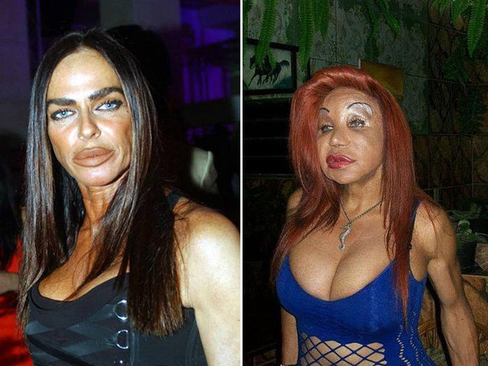 Plastic Surgery Gone Wrong (17 pics)