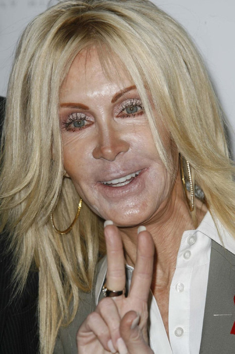 Plastic Surgery Gone Wrong (17 pics)