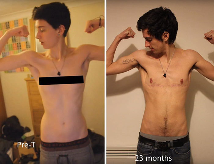 Trans Teen Documents 3 Year Transformation Into A Man (20 pics + video)