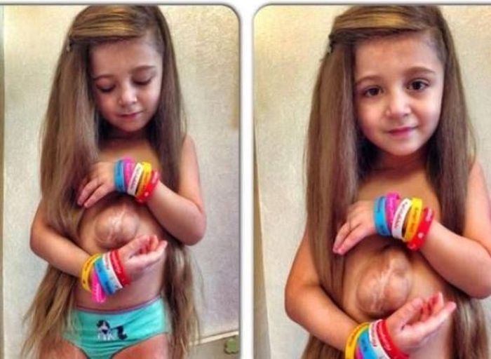 Six Year Old Girl Born With Her Heart Outside Of Her Chest Is Defying The Odds (8 pics)