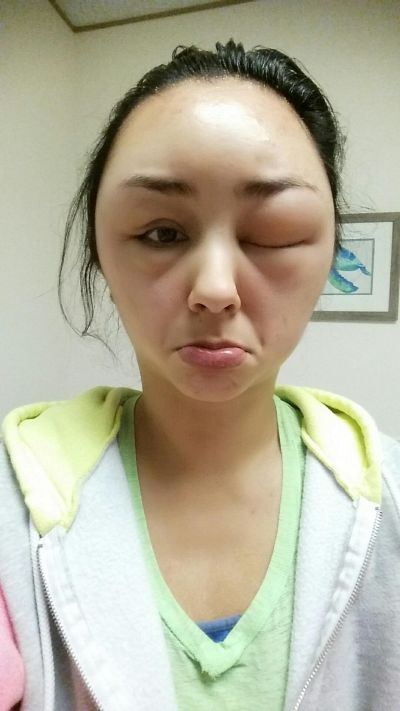 Girl Ends Up With A Swollen Face After Having A Bad Reaction To Hair Dye (8 pics)