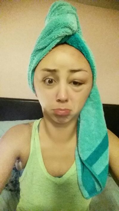 Girl Ends Up With A Swollen Face After Having A Bad Reaction To Hair Dye (8 pics)