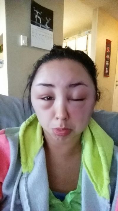 Girl Ends Up With A Swollen Face After Having A Bad Reaction To Hair Dye (8 pics)