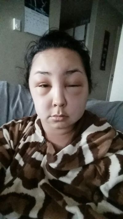 Girl Ends Up With A Swollen Face After Having A Bad Reaction To Hair Dye (8 pics)