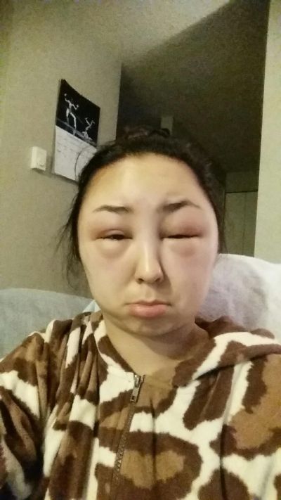 Girl Ends Up With A Swollen Face After Having A Bad Reaction To Hair Dye (8 pics)