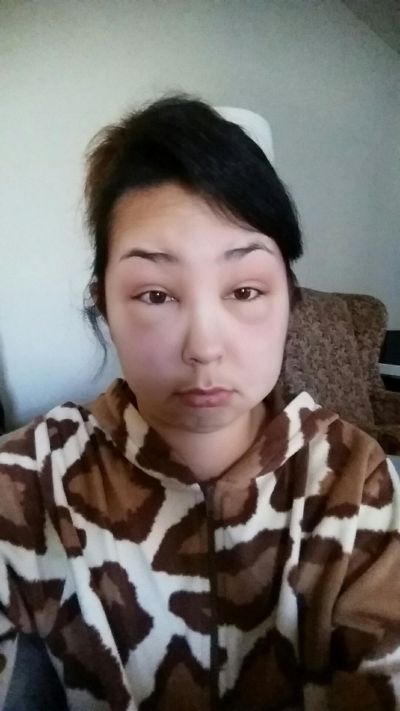 Girl Ends Up With A Swollen Face After Having A Bad Reaction To Hair Dye (8 pics)