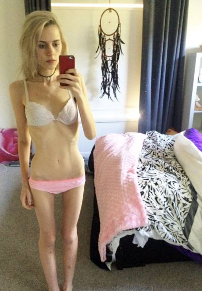 Teenage Girl Almost Dies After Giving Up Food And Water To Lose Weight (20 pics)