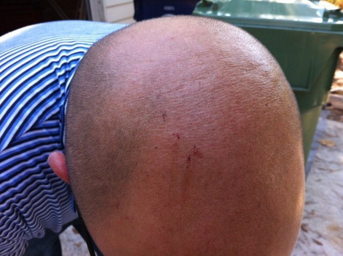 Man Gets Bit In The Head By A Snake After Walking Out His Own Door (5 pics)
