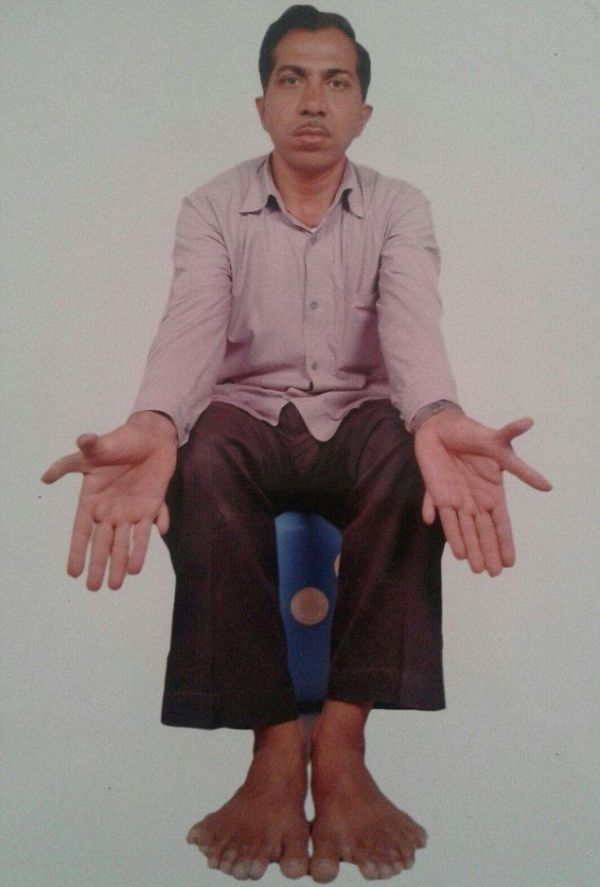 A Man In India Holds The Guinness World Record For Having The Most Fingers (7 pics)