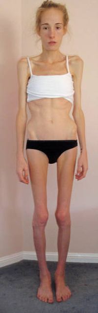 Girl Makes Amazing Recovery After Almost Losing Her Life To Anorexia (16 pics)