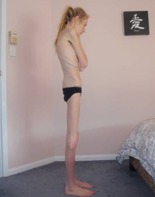 Girl Makes Amazing Recovery After Almost Losing Her Life To Anorexia (16 pics)