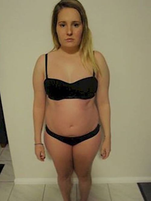 Girl Makes Amazing Recovery After Almost Losing Her Life To Anorexia (16 pics)