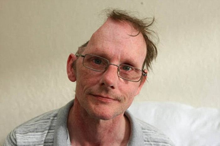 Man Ends Up With Half A Head After Suffering A Stroke (3 pics)