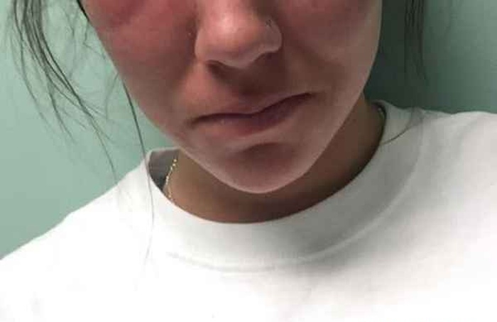 Girl Has Awful Allergic Reaction To Poison Ivy (2 pics)