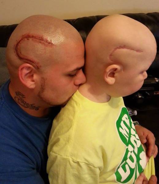 Loving Father Gets Tattoo On His Head To Match His Son's Scar (6 pics)