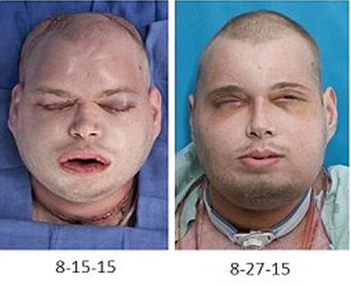 New York Firefighter Adjusts To His New Life After Receiving A Face Transplant (8 pics)