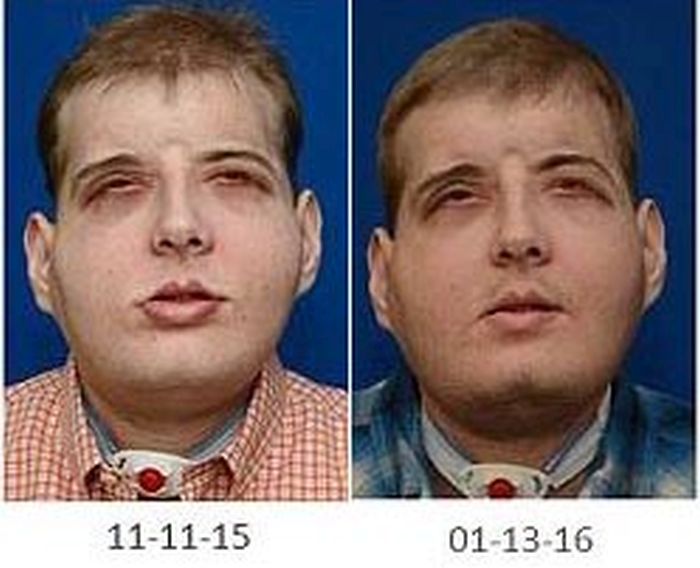 New York Firefighter Adjusts To His New Life After Receiving A Face Transplant (8 pics)