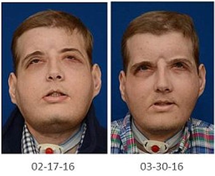 New York Firefighter Adjusts To His New Life After Receiving A Face Transplant (8 pics)