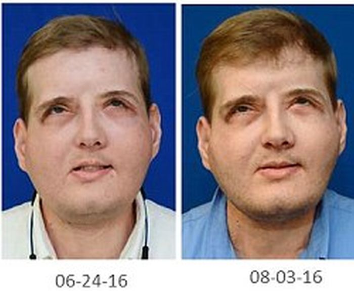 New York Firefighter Adjusts To His New Life After Receiving A Face Transplant (8 pics)