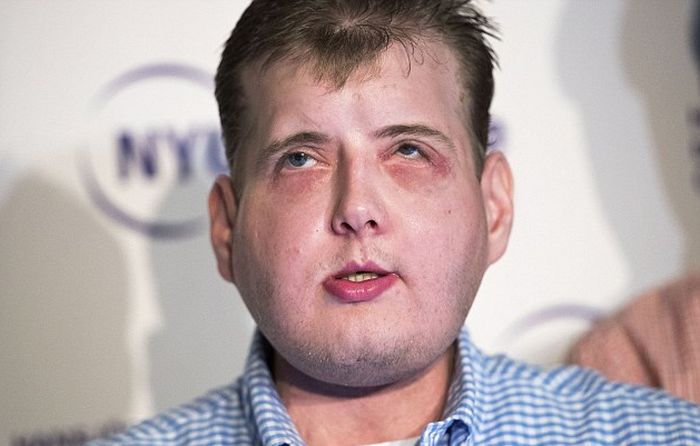 New York Firefighter Adjusts To His New Life After Receiving A Face Transplant (8 pics)