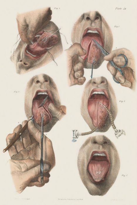 15 Disturbing Medical Instruments From The Past That Will Make You Cringe (15 pics)