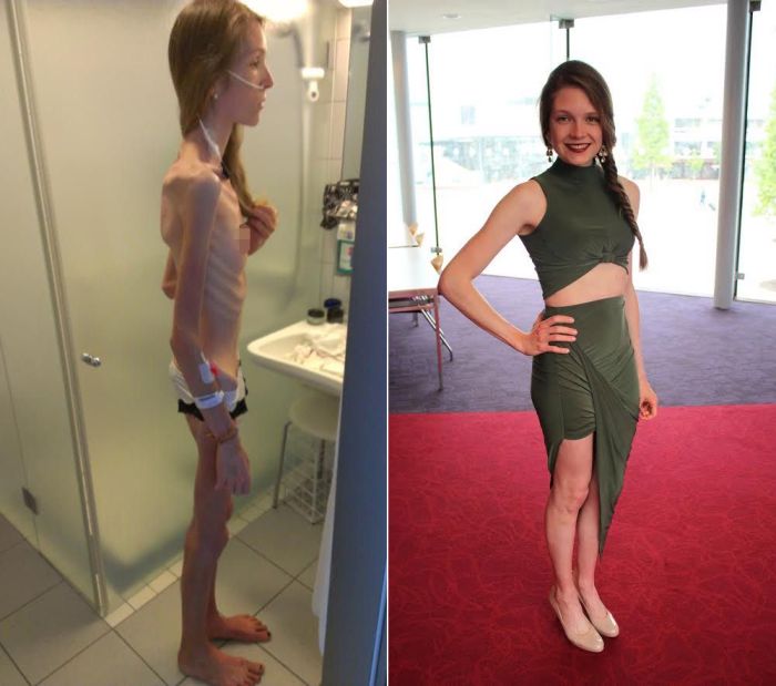 Anorexic Girl Inspires People To Get Healthy After Being Days Away From 