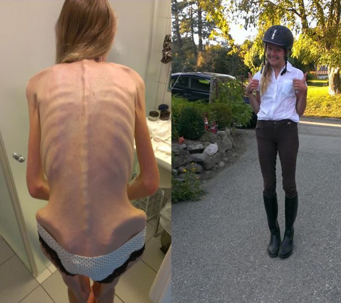 Anorexic Girl Inspires People To Get Healthy After Being Days Away From Dea...