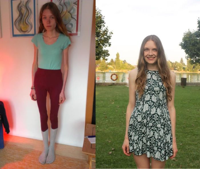 Anorexic Girl Inspires People To Get Healthy After Being Days Away From Death (5 pics)