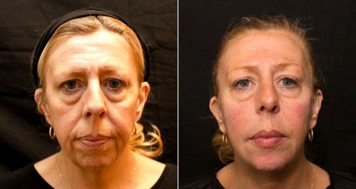 One Of These Women Has Had Filler For 10 Years (4 pics)
