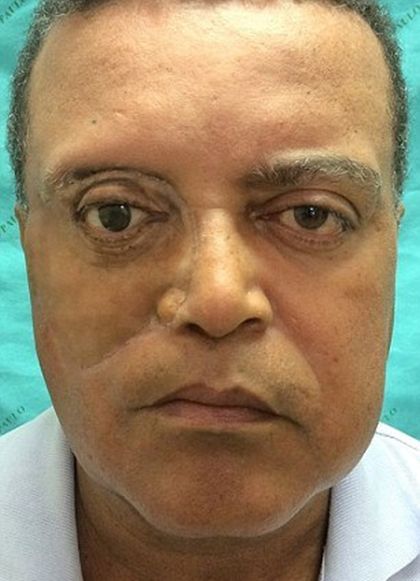 Brazlians Create Incredible Facial Prosthesis Using A 3D Printer (3 pics)